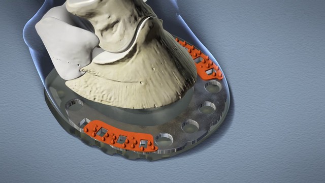 illustration of a hoof shod with a composite horseshoe, detailed view on the anatomy of the hoof and the knob arrays of the horseshoe